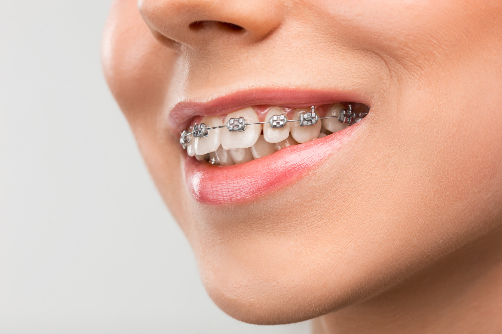 Beautiful young woman with teeth braces Beautiful young woman with teeth braces<br />